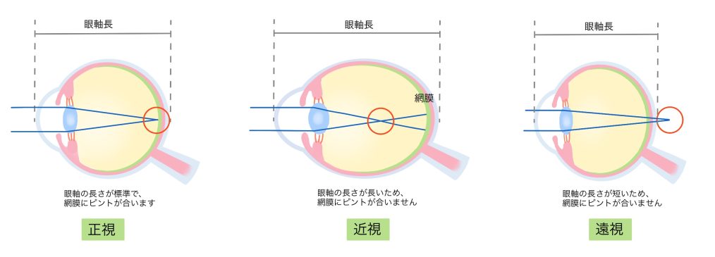 子どもの目 「弱視」 | 子供 弱視 見え方 : 弱視「弱視についてきちんと知りたい!」 – QTHYQ
