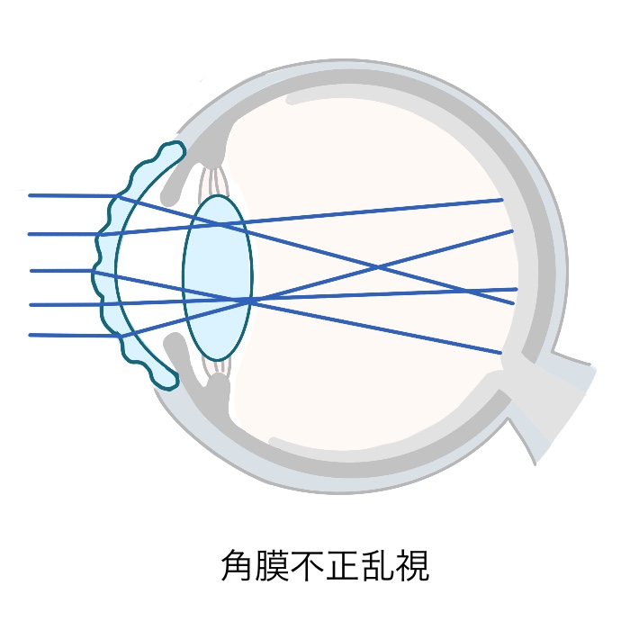 乱視が強い _ 乱視 見え方 画像 – EWDF