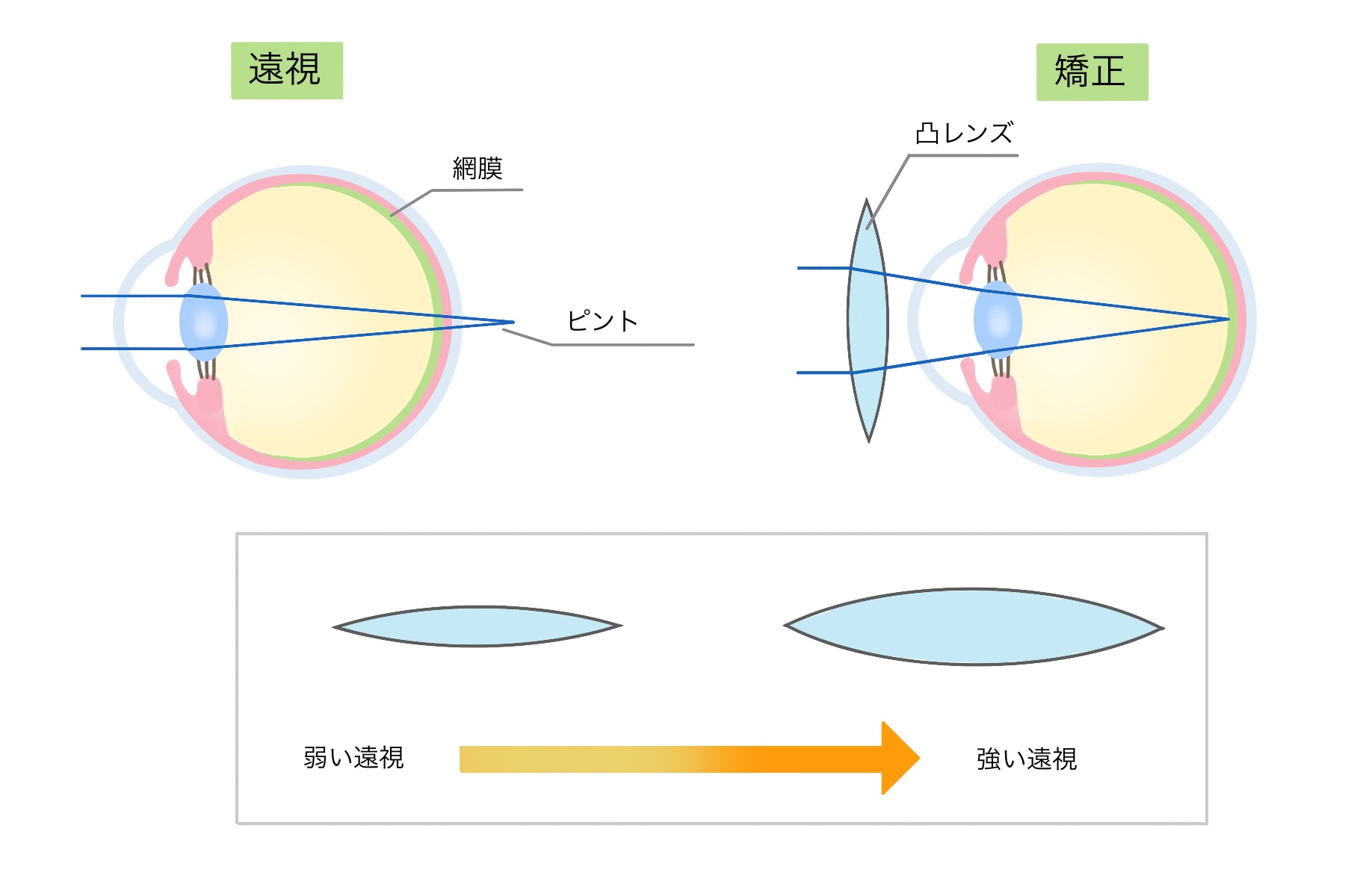 遠視 - HOYA株式会社