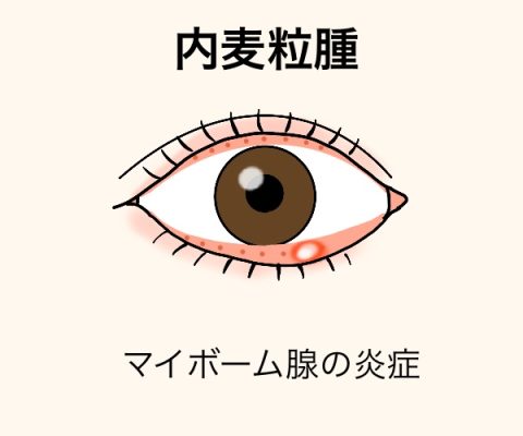 ものもらい - HOYA株式会社