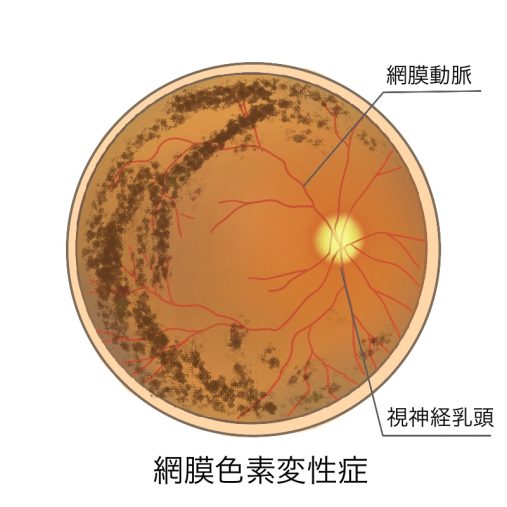 網膜色素沈着症 _ 網膜色素変性症 見え方 写真 – BEIORX