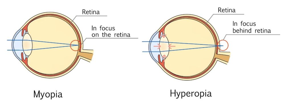 Hyperopia - HOYA Corporation