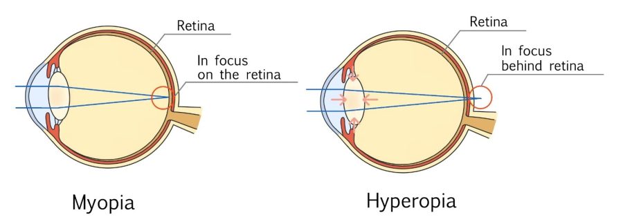 Hyperoptic Vision Hyperopia - HOYA Corporation