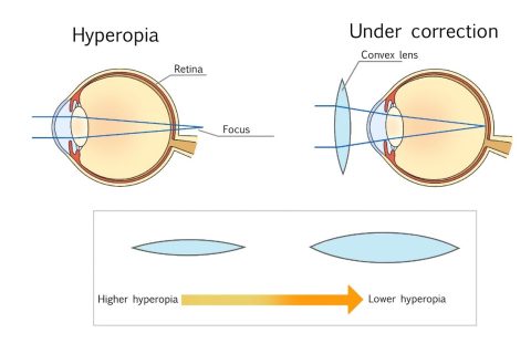 Icelus Hyperopes Hyperopia - HOYA Corporation