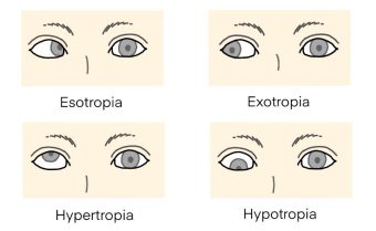 Strabismus Vision Example Strabismus - HOYA Corporation