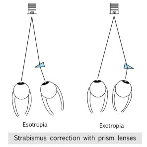 Strabismus - HOYA Corporation