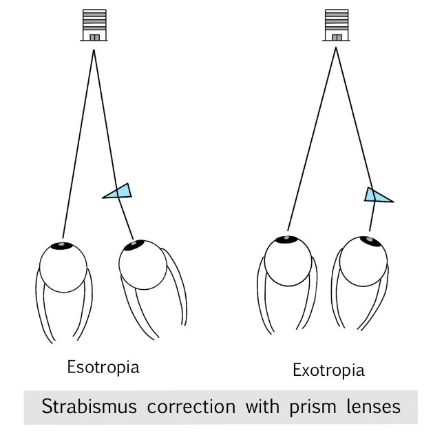 Strabismus Vision Example Strabismus - HOYA Corporation
